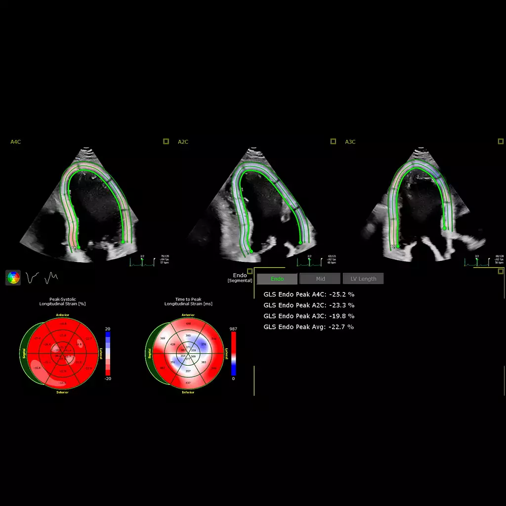 Gls Pattern Echocardiography Beverly Hills – Heart Ultrasound