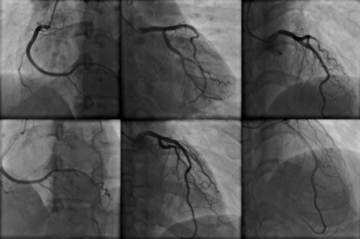 Cardiac Catheterization Beverly Hills | Coronary Angiogram