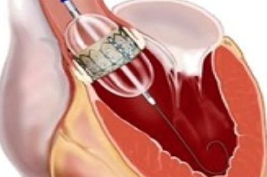 Transcatheter Aortic Valve Replacement Beverly Hills | Dr Filsoof