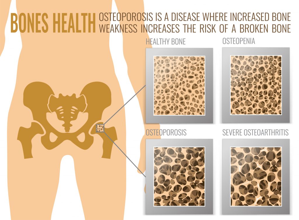 i-have-osteoporosis-what-are-my-treatment-options