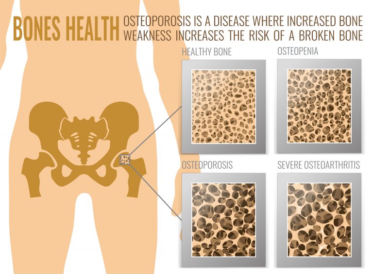Osteoporosis Bones Poster Beverly Hills Cardiovascular